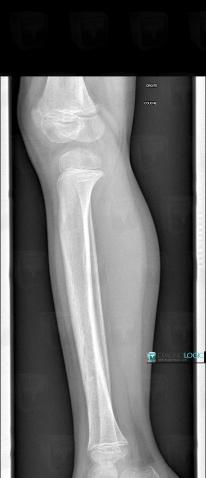 Fracture, Tibia - Mid part, X rays