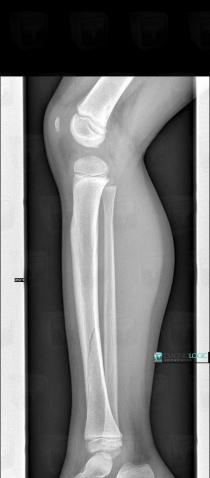 Fracture, Tibia - Mid part, X rays