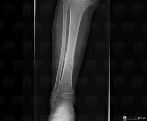 Fracture, Tibia -moyen, Radio