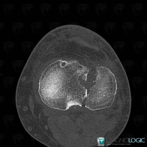 Fracture, Tibia - Proximal part, CT