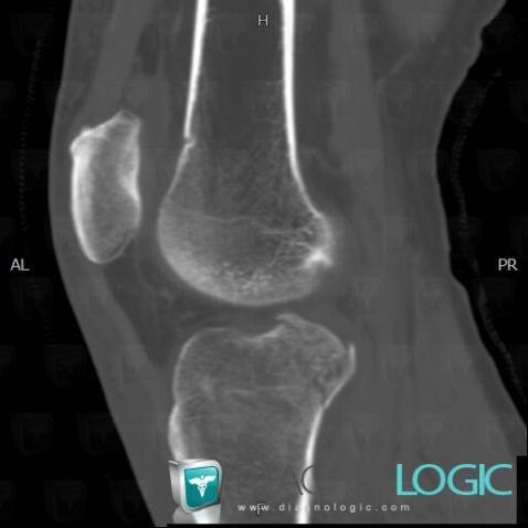 Fracture, Tibia - Proximal part, CT