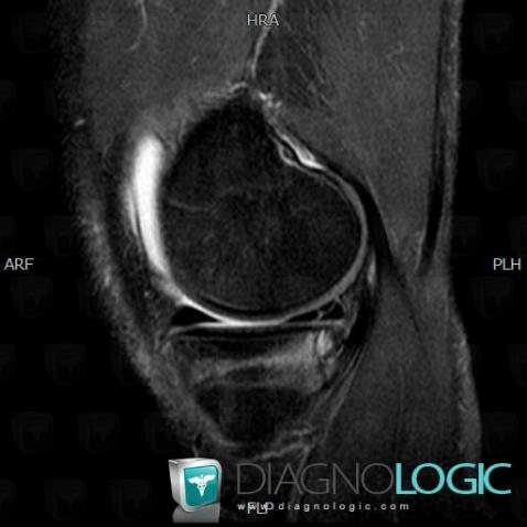 Fracture, Tibia - Proximal part, MRI