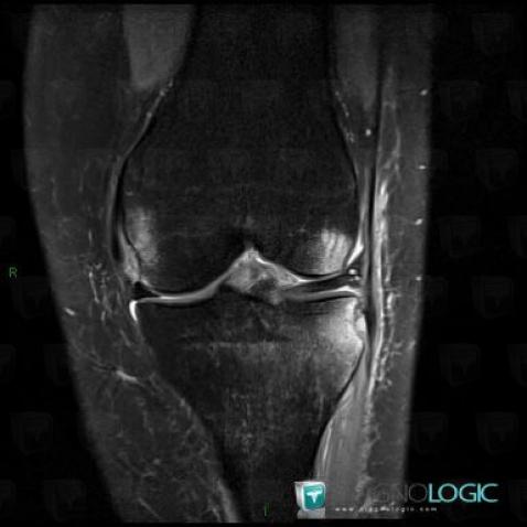 Fracture, Tibia - Proximal part, MRI