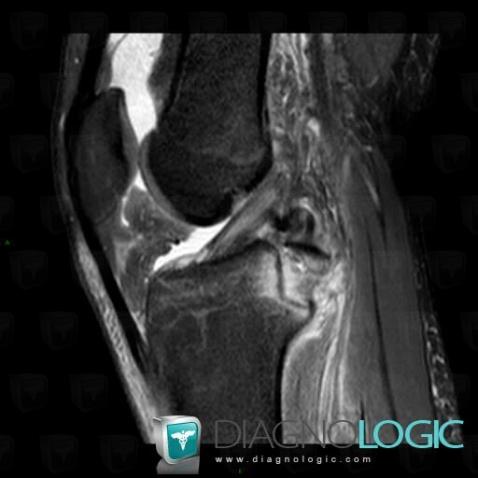 Fracture, Tibia - Proximal part, MRI