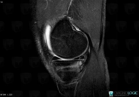 Fracture, Tibia - Proximal part, MRI