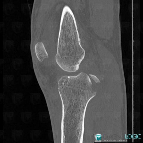 Fracture, Tibia -supérieur, Scanner