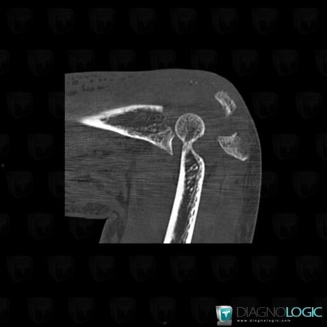 Fracture, Ulna - Proximal part, CT