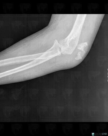 Fracture, Ulna - Proximal part, X rays