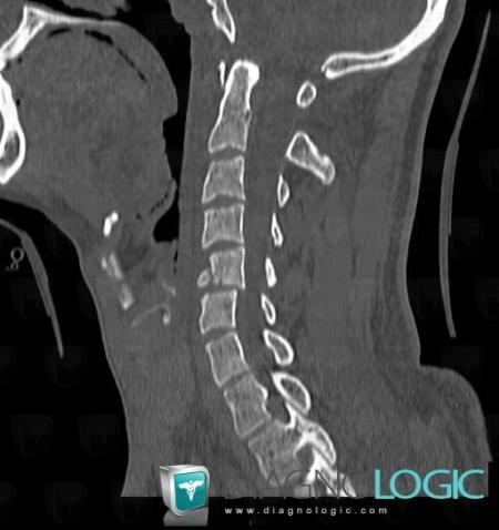 Fracture, Vertebral body / Disk, CT