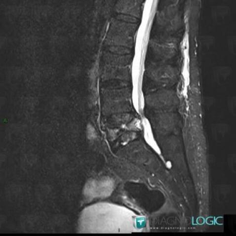 Fracture vertébrale, Corps vertébral / Disque, IRM