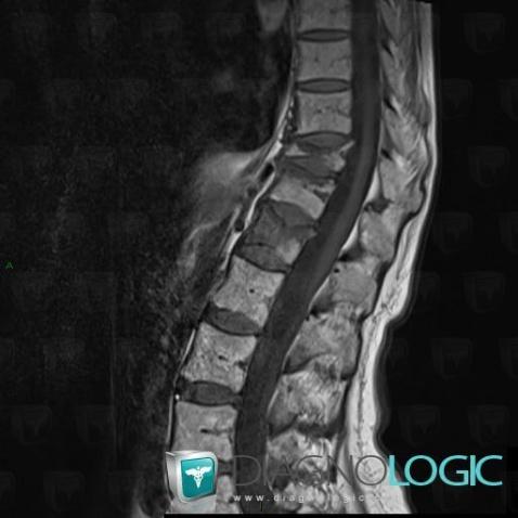 Fracture vertébrale, Corps vertébral / Disque, IRM