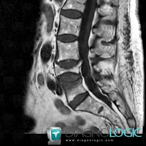 Fracture vertébrale, Corps vertébral / Disque, IRM