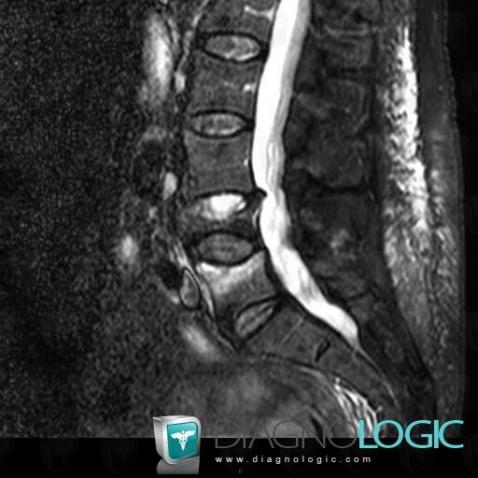 Fracture vertébrale, Corps vertébral / Disque, IRM