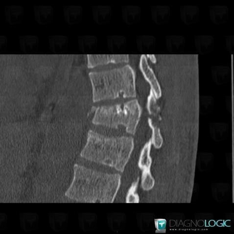 Fracture vertébrale, Corps vertébral / Disque, Scanner