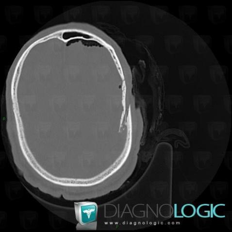 Fracture, Voute-crâne, Os temporal, Scanner