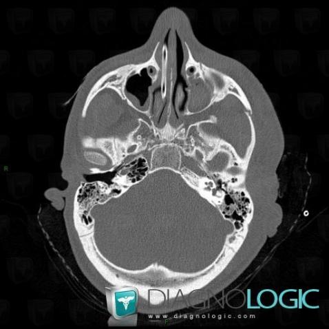 Radiology case : Hemosinus (CT) - Diagnologic