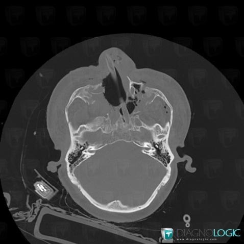 Fracture, Zygomatic / malar bone, CT