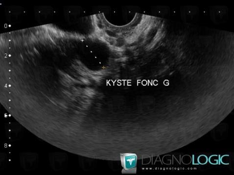 Functional cyst, Adnexa / Ovary fallopian tube, Pelvis / Perineum, US