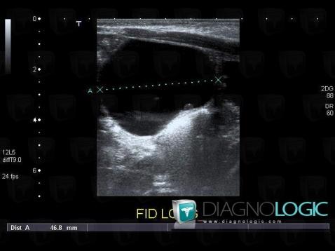 Functional cyst, Adnexa / Ovary fallopian tube, Pelvis / Perineum, US