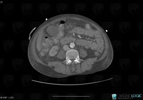 Gallbladder rupture, Gallbladder, CT