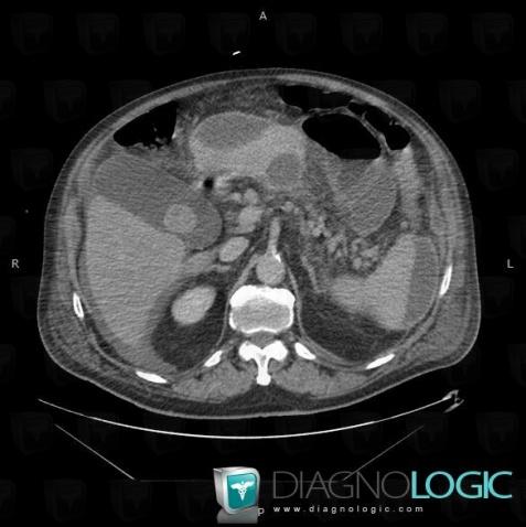 Gallstone, Gallbladder, CT
