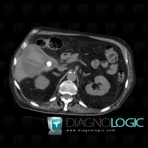 Gallstone, Gallbladder, CT