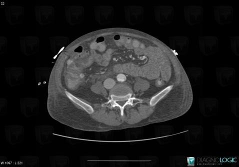 Gallstone, Mesentery / Peritoneum, CT