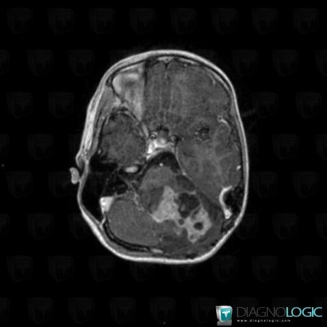 Gangliocytoma, Cerebellar hemisphere, Posterior fossa, MRI