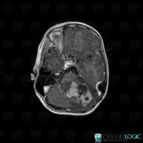 Gangliocytoma, Cerebellar hemisphere, Posterior fossa, MRI
