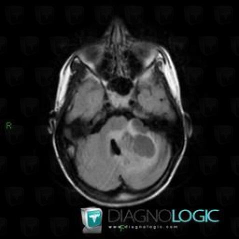 Gangliocytoma, Posterior fossa, MRI