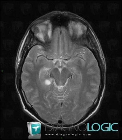 Ganglioglioma, Cerebral hemispheres, MRI