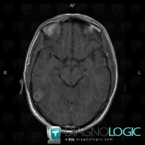 Radiology case : Ganglioglioma (MRI) - Diagnologic