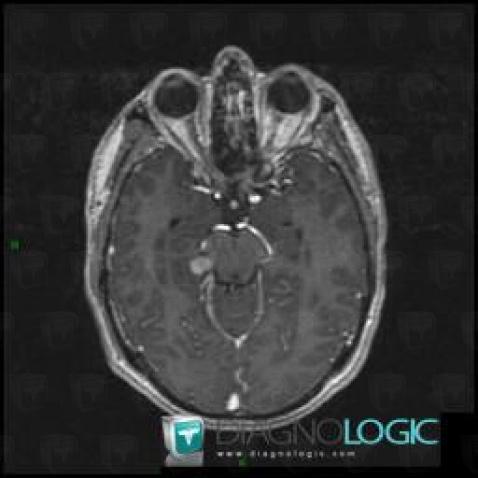 Ganglioglioma, Cortico subcortical region, Cerebral hemispheres, MRI