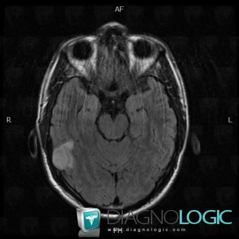 Ganglioglioma, Cortico subcortical region, Cerebral hemispheres, MRI