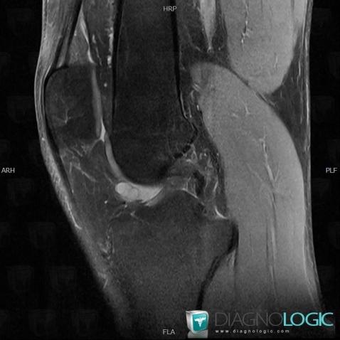 Ganglion cyst, Other soft tissues/nerves - Knee, MRI