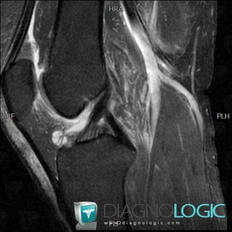 Ganglion cyst, Other soft tissues/nerves - Knee, MRI