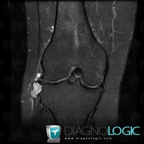 Ganglion cyst, Other soft tissues/nerves - Knee, MRI