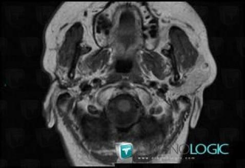 Ganglion intra parotidien, Parotide et autres glandes salivaires, IRM