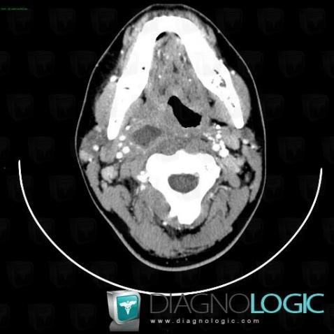 Ganglion intra parotidien, Parotide et autres glandes salivaires, Scanner