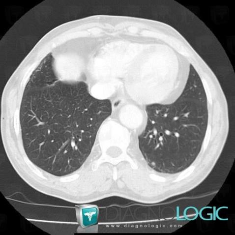 Ganglion intrapulmonaire, Parenchyme pulmonaire, Scanner