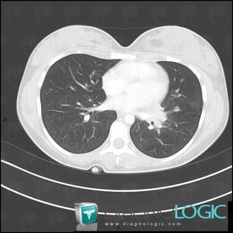 Ganglion intrapulmonaire, Parenchyme pulmonaire, Scanner