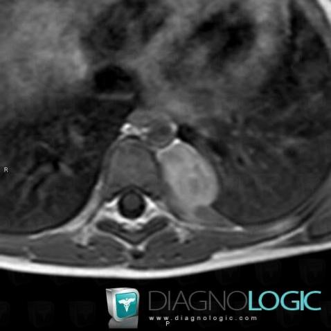 Ganglioneuroma, Mediastinum, Paraspinal, MRI