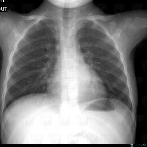 Ganglioneuroma, Mediastinum, X rays