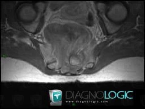 Ganglioneuroma, Pelvis / Perineum, MRI