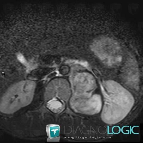 Ganglioneuroma, Retroperitoneum, MRI