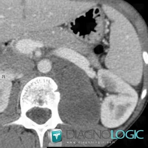 Ganglioneuroma, Retroperitoneum, Paraspinal, CT