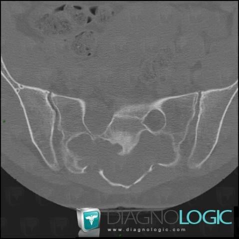 Ganglioneuroma, Sacrum / Coccyx, CT