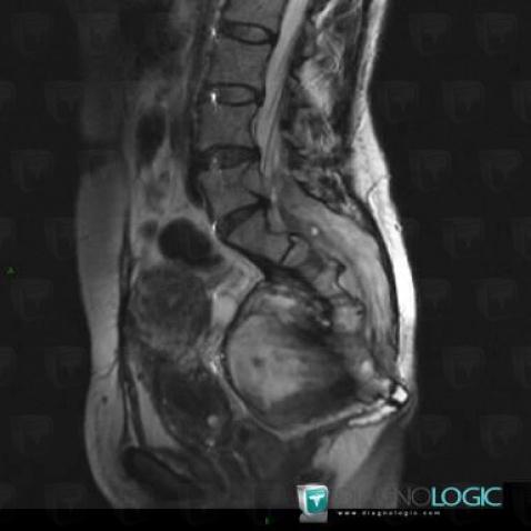 Ganglioneuroma, Sacrum / Coccyx, Spinal canal / Cord, MRI