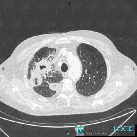 Gangrene-lung, Pulmonary parenchyma, CT