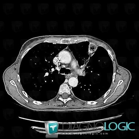 Gangrène pulmonaire, Parenchyme pulmonaire, Scanner